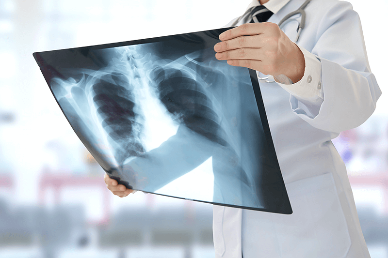 Перераховано п’ять неочевидних симптомів раку легенів